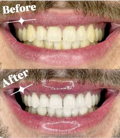 Real client before and after teeth whitening result 3