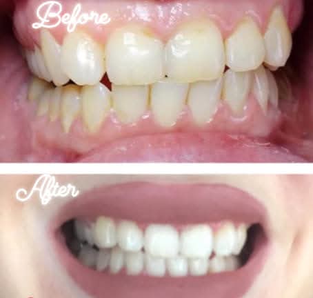 Real client before and after teeth whitening result 4