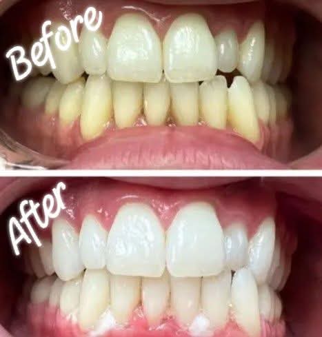 Real client before and after teeth whitening result 2