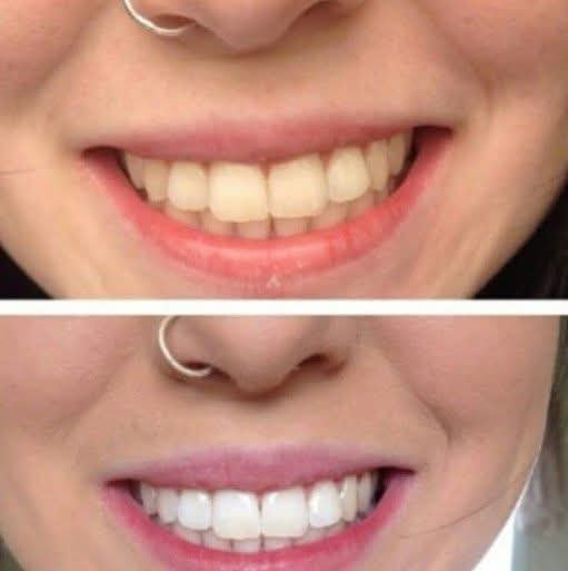 Real client before and after teeth whitening at Lumiere Kildare